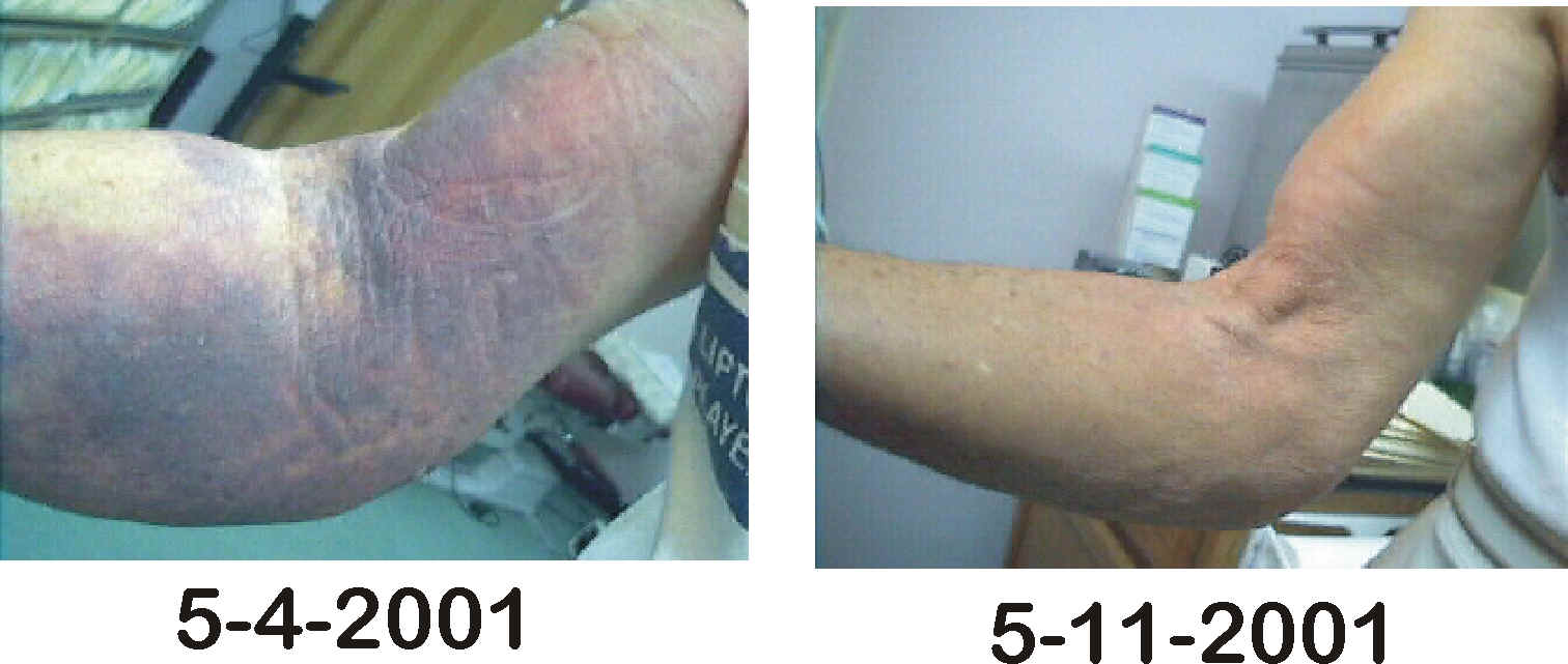 Electrotherapy Before After
